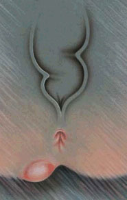 Abces Anal Abces Anal