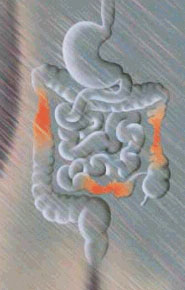 Boala Crohn Boala Crohn