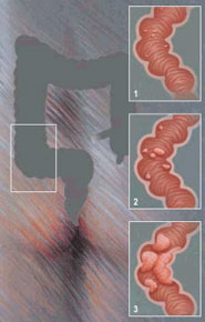 Cancer de Colon Cancer de Colon