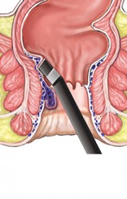 IR Haemorrhoid Coagulation