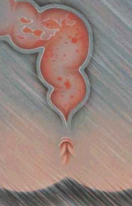 Colita Ulcerativa Colita Ulcerativa