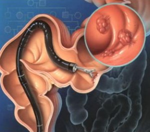 Colonoscopia ca diagnostic in cancerul de colon
