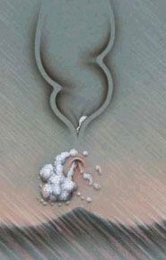 Condilomatoza Anala Condilomatoza Anala