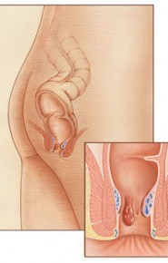 Diagnostic Hemoroizi
