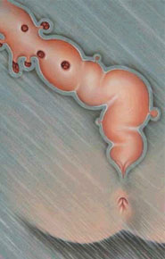 Diverticuloza Diverticuloza