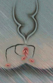 Fistula Perianala Fistula Perianala