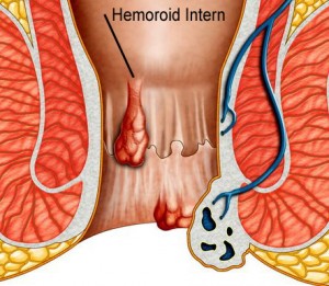 Hemoroizi Interni