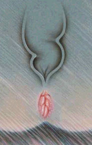 Marisce Hemoroidale Marisce Hemoroidale