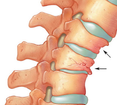 Osteoporoza coloanei vertebrale Atunci cand vertebrele sunt slabite, ele se pot fractura si tasa