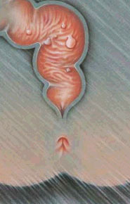 Polipi Colon Polipi Colon