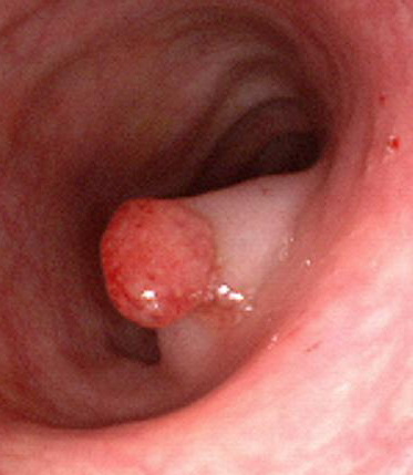 Polipii colonici pot fi sesili, cu o baza larga de implantare sau pediculati