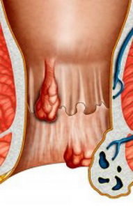Prezentarea generala a tratamentului pentru hemoroizi