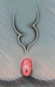 Prolaps Rectal Prolaps Rectal