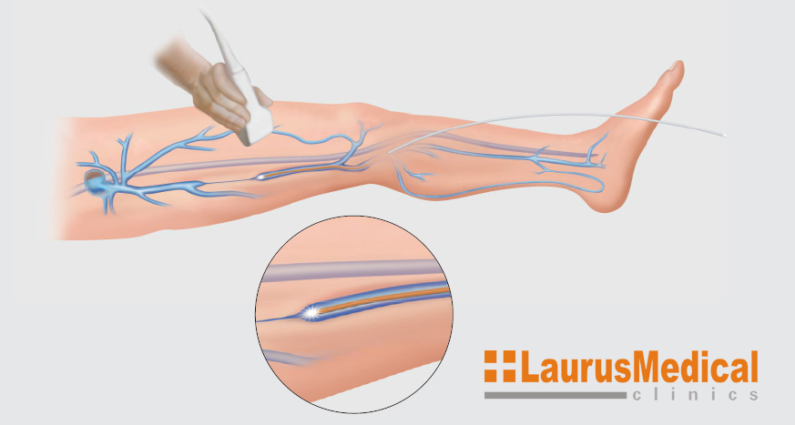 LaurusMedical - Tratament Varice Laser Endo-Venos LaurusMedical - Tratament Varice Laser Endo-Venos
