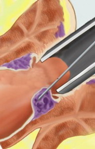 Tratamentul hemoroizilor prin scleroterapie Tratamentul hemoroizilor prin scleroterapie