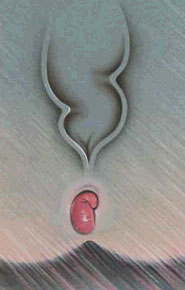 Tromboza Anala Tromboza Anala