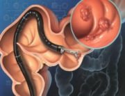 Colonoscopia ca diagnostic in cancerul de colon