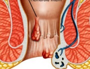 Hemoroizi Interni