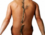 Incidenta fracturilor la barbati datorate osteoporozei este jumatate din cea de la femei, dar mortalitatea prin fractura de sold este dubla