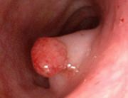 Polipii colonici pot fi sesili, cu o baza larga de implantare sau pediculati