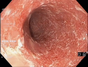 colita nedeterminata M 34 ani