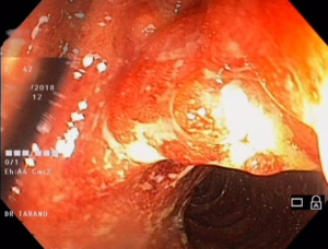 colita ulceroasa F 42 ani