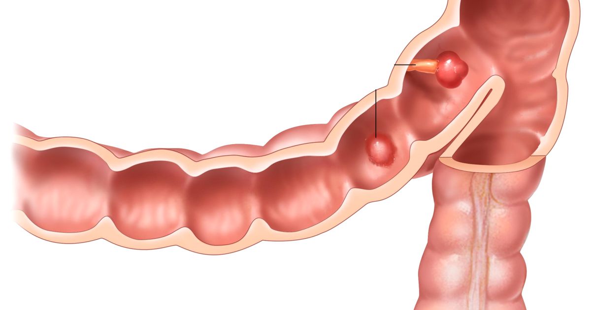polipectomia endoscopica
