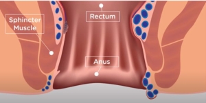 tratament hemoroizi laser