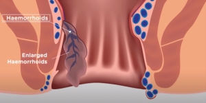 tratament hemoroizi laser