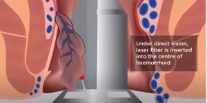tratament hemoroizi laser