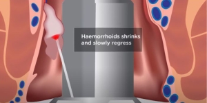 tratament hemoroizi laser